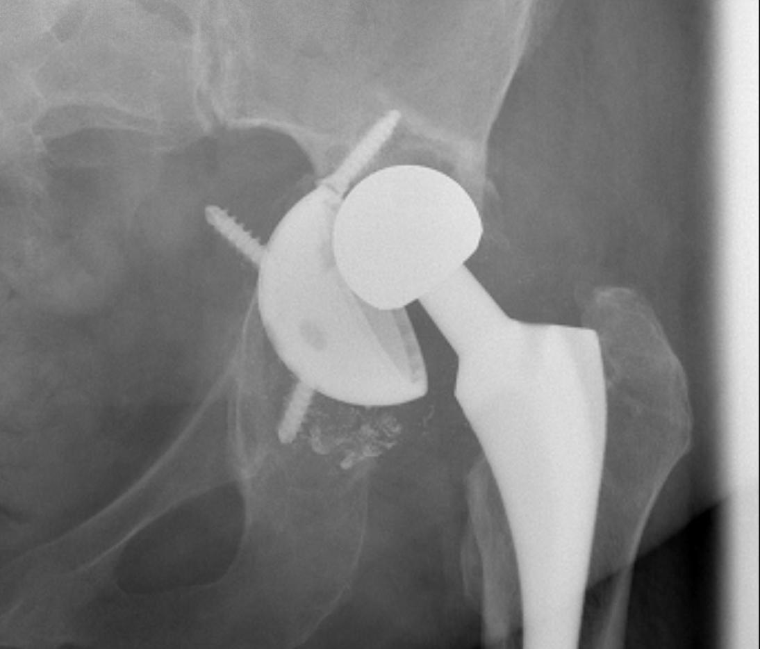 Revision THR Pelvic Discontinuity0001